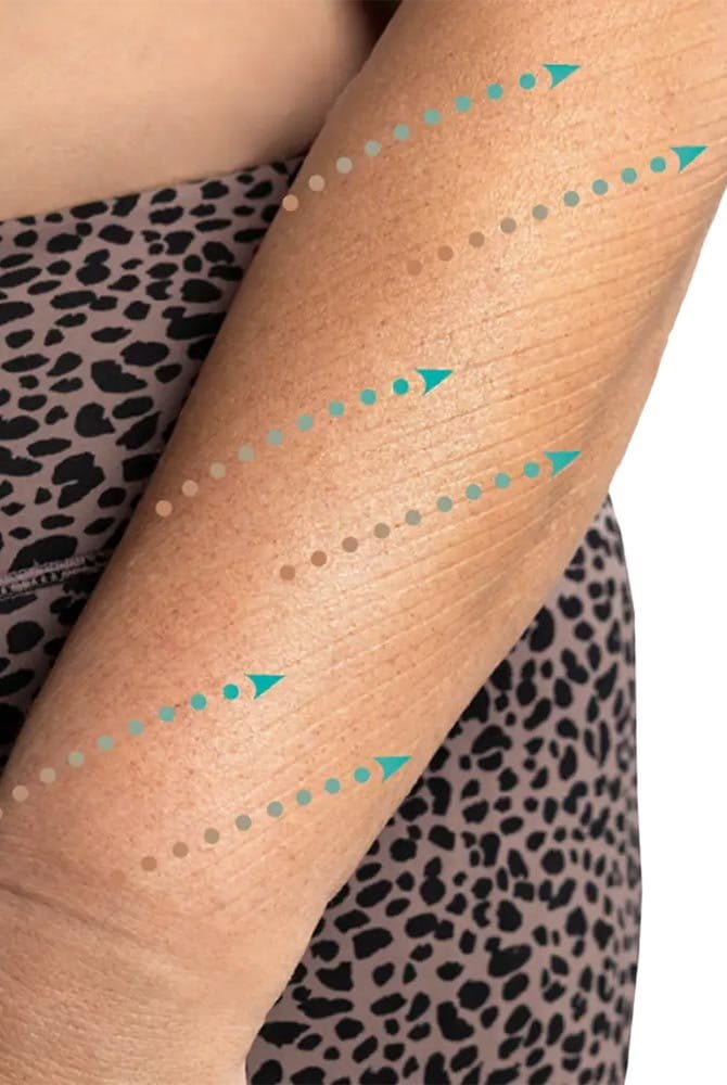 Abdrücke der innenliegenden Silikonstreifen zur Unterstützung des Lymphabflusses