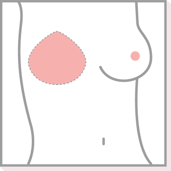 Teilprothesen mit Delta-Form