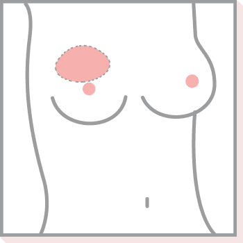 Teilprothesen in Varia-Form