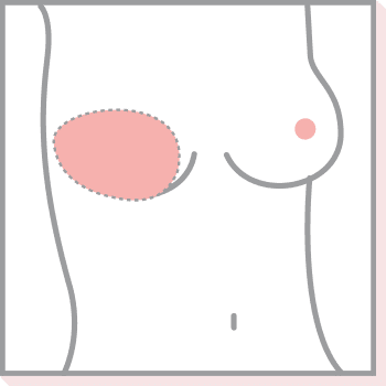 Teilprothesen mit ovaler Form